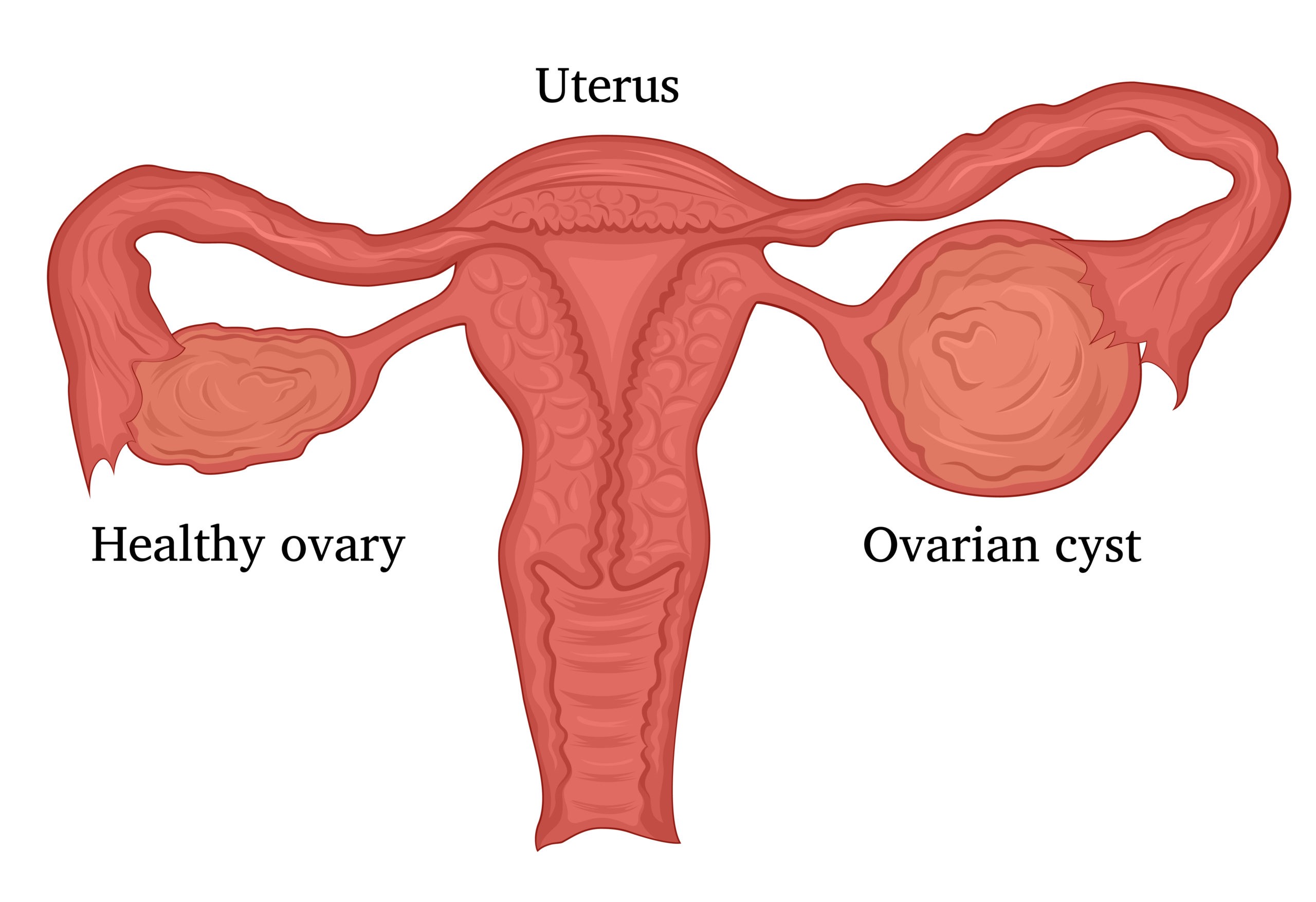 Ovarian cysts